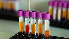 В Новочеркасске за прошедшие сутки 5 человек заразились коронавирусом